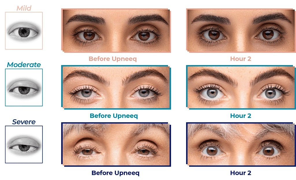Eyelid lifting effects of Upneeq at different times