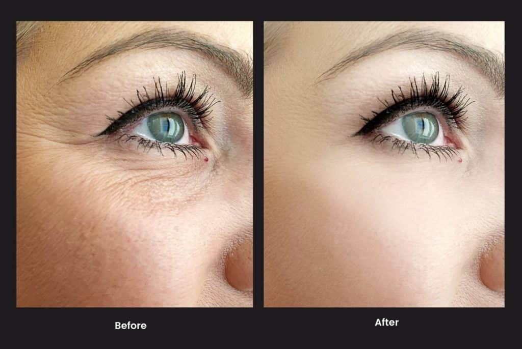 Women before and after PRF under eye injections reduce under eye bags and wrinkles | Viata Aesthetics and Wellness in Katy TX