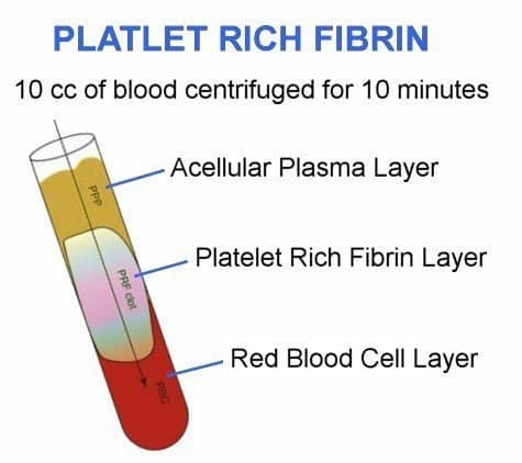 Platelet Rich Fibrin Layers | Viata Aesthetics and Wellness in Katy TX